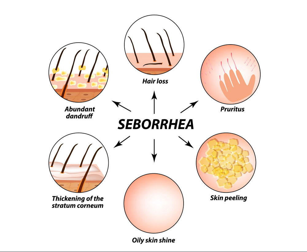 Схема лечения себорейного дерматита на голове