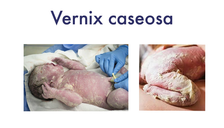 Vernix Caseosa - первородне змащення