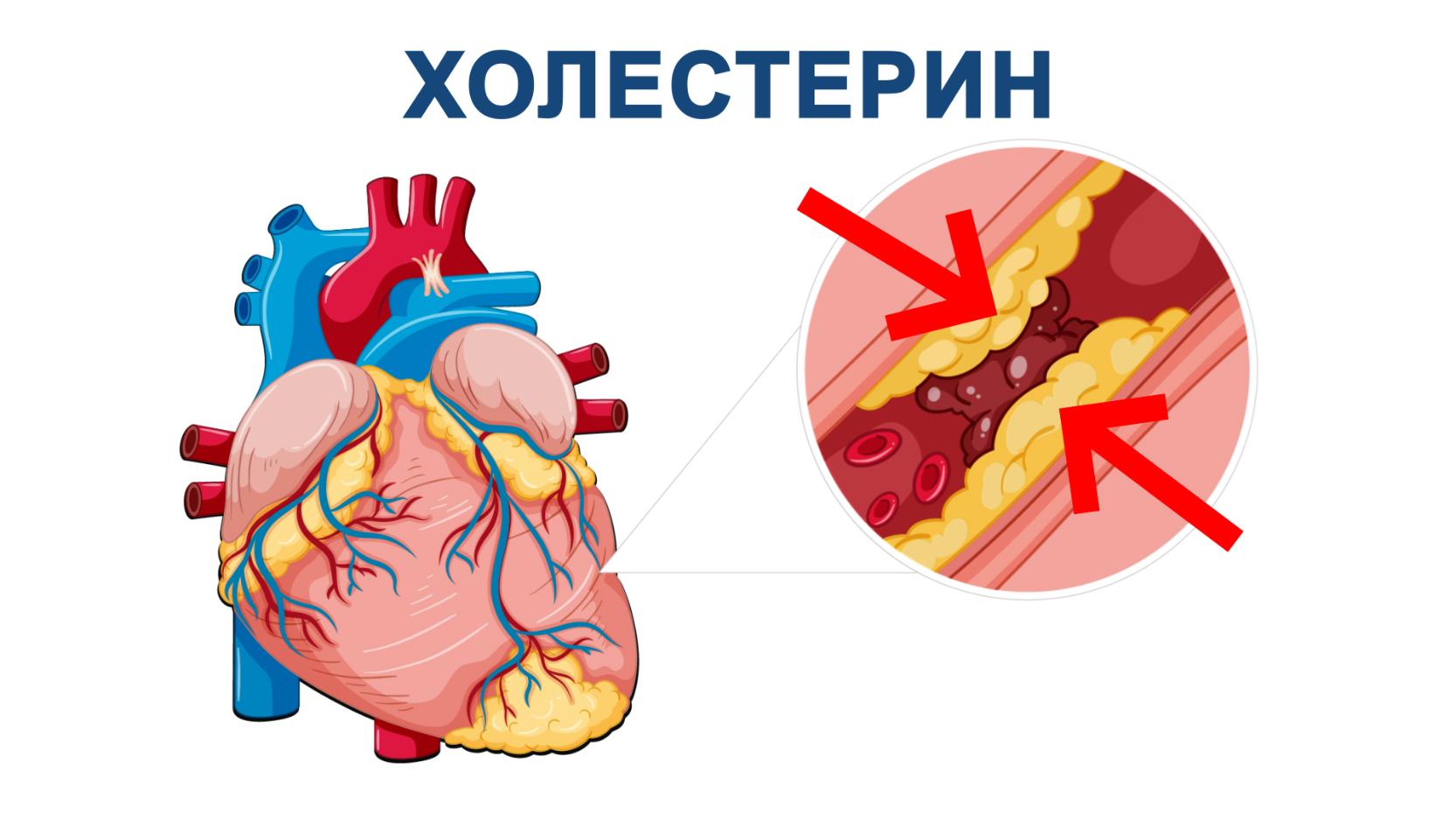 Високий рівень холестерину є загрозливим для роботи вашого серця