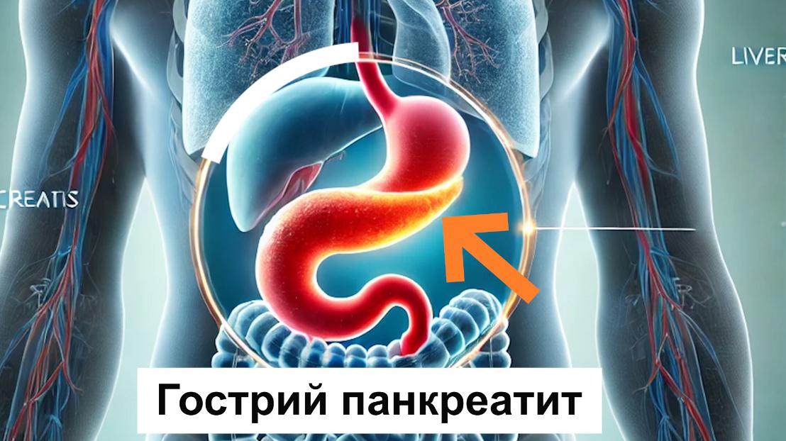 Симптоми гострого панкреатиту