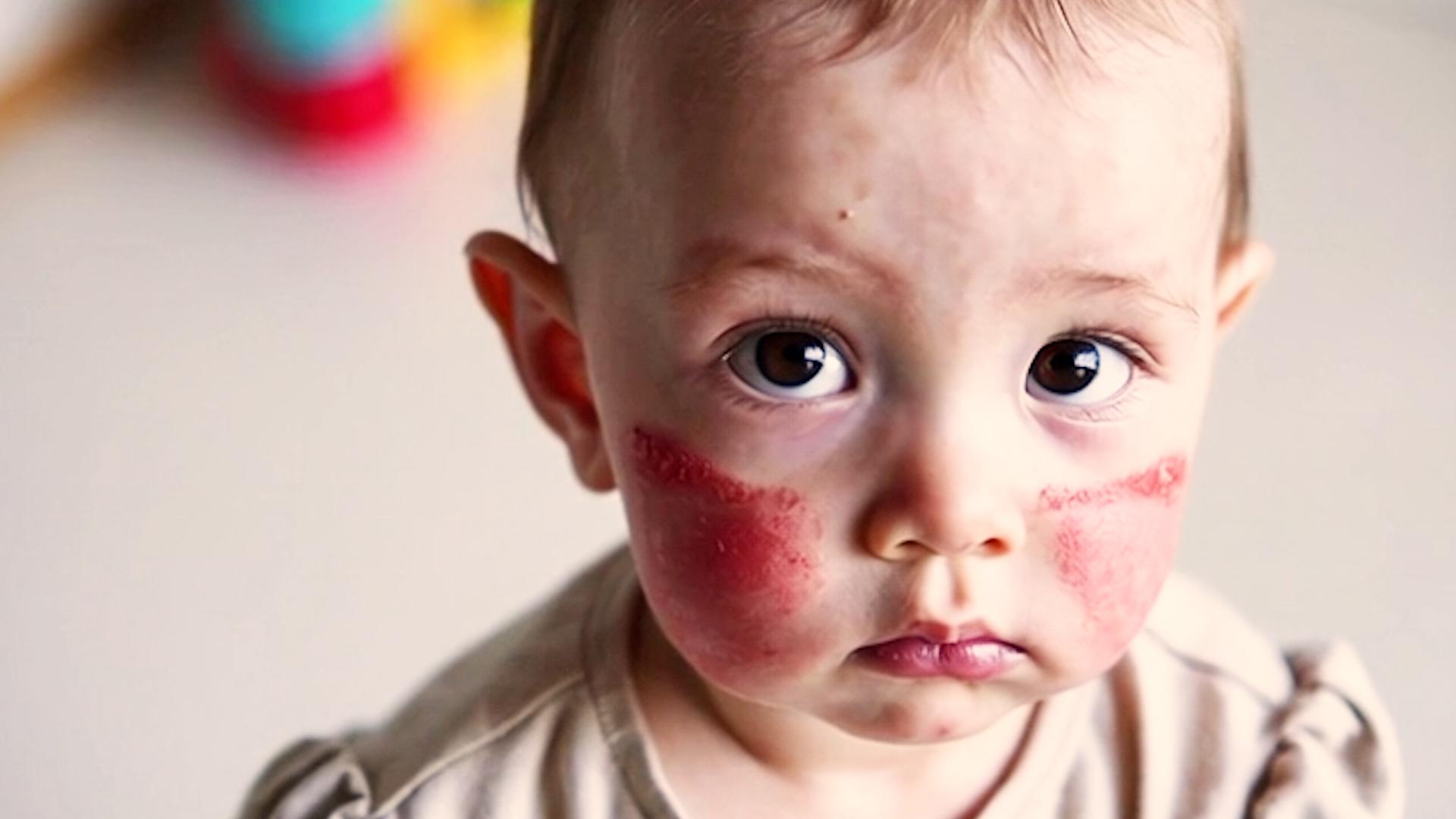 харчова алергія у дітей реакція шкіри після вживання продуктів